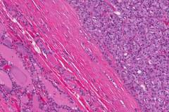 Follicular variant papillary thyroid carcinoma