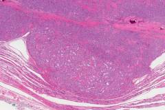 Follicular variant papillary thyroid carcinoma