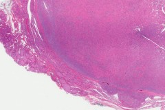 Follicular variant papillary thyroid carcinoma