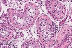 Germ cell neoplasia in situ of the testis