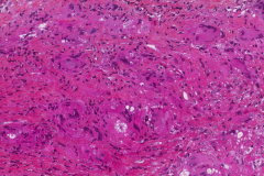 Giant cell myocarditis