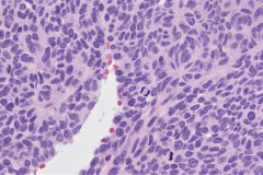 Malignant glomus tumour