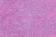 Goblet cell adenocarcinoma of the appendix