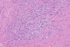 Goblet cell adenocarcinoma of the appendix