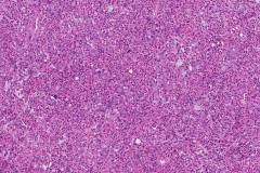 Goblet cell adenocarcinoma of the appendix