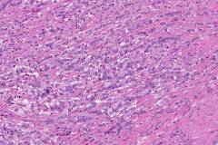 Goblet cell adenocarcinoma of the appendix