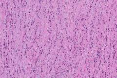 Goblet cell adenocarcinoma of the appendix