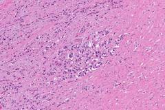 Goblet cell adenocarcinoma of the appendix