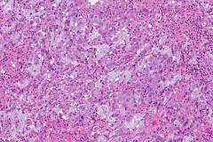 Goblet cell adenocarcinoma of the appendix