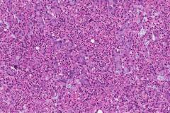 Goblet cell adenocarcinoma of the appendix