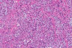 Goblet cell adenocarcinoma of the appendix
