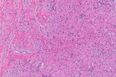 Goblet cell adenocarcinoma of the appendix