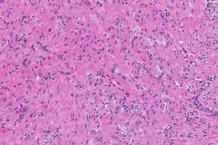 Goblet cell adenocarcinoma of the appendix