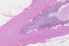 Goblet cell adenocarcinoma of the appendix