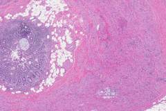 Goblet cell adenocarcinoma of the appendix