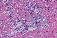 Goblet cell adenocarcinoma of the appendix