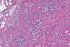Goblet cell adenocarcinoma of the appendix