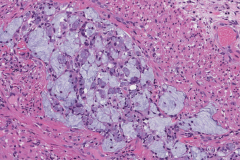 Goblet cell adenocarcinoma of the appendix