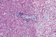 Goblet cell adenocarcinoma of the appendix