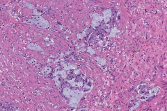 Goblet cell adenocarcinoma of the appendix