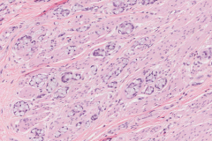Goblet cell adenocarcinoma of the appendix