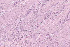 Goblet cell adenocarcinoma of the appendix