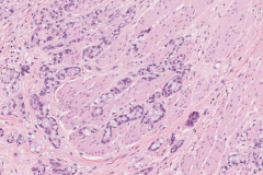 Goblet cell adenocarcinoma of the appendix