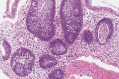 Graft versus host disease in the colon