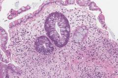 Graft versus host disease in the colon