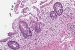 Graft versus host disease in the colon