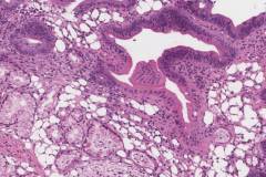 Graft versus host disease in the duodenum