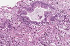 Graft versus host disease in the gastroesophageal junction