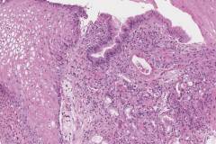 Graft versus host disease in the gastroesophageal junction