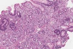 Graft versus host disease in the stomach