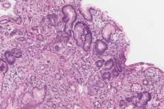 Graft versus host disease in the stomach
