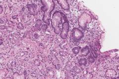 Graft versus host disease in the stomach