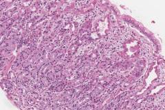 Graft versus host disease in the stomach
