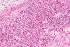 Hemangioma of the kidney