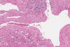 Venous hemangioma in the nasal cavity