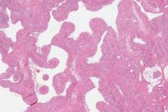 Venous hemangioma in the nasal cavity