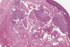 Venous hemangioma of the tongue