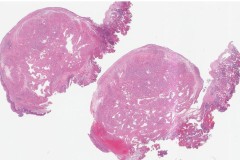 Venous hemangioma in the nasal cavity