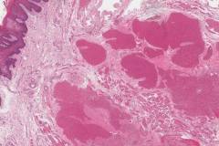 Venous hemangioma in the tongue