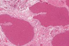 Venous hemangioma in the tongue