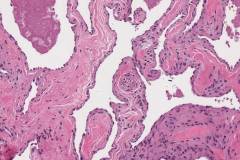 Venous hemangioma of the tongue