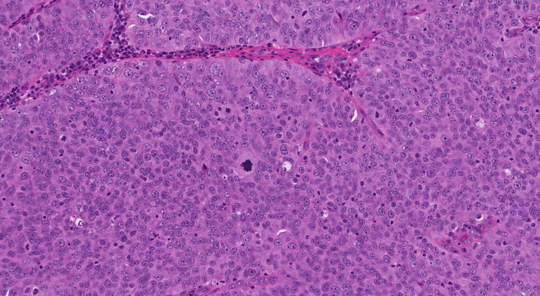 icd 10 code for invasive papillary urothelial carcinoma