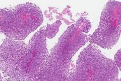 High grade papillary urothelial carcinoma