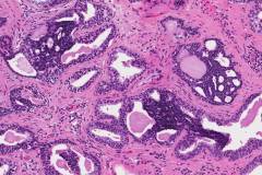 High grade prostatic intraepithelial neoplasia with neuroendocrine differentiation