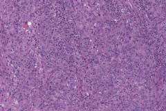 High grade serous carcinoma of the fallopian tube