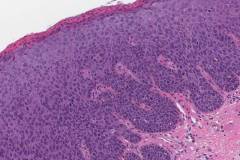 High grade squamous intraepithelial lesion of the perianal skin